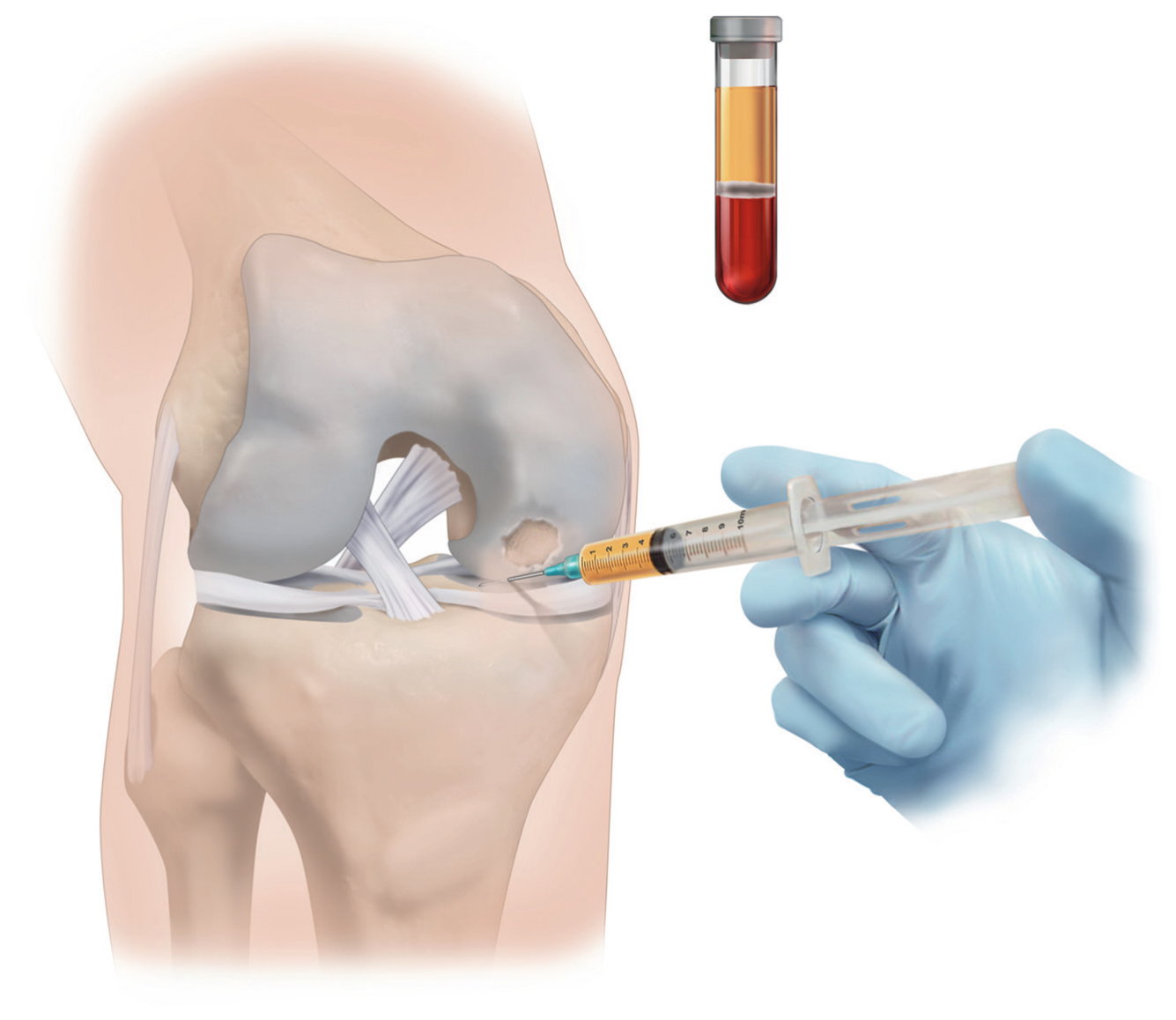 슬관절에 시행하는 orthobiologic 주사를 보여주는 그림. 진료실이나 시술실에서 시행 가능한 간단한 술기이다. PRP 같은 orthobiologic 제제를 anterior portal 또는 anterolate