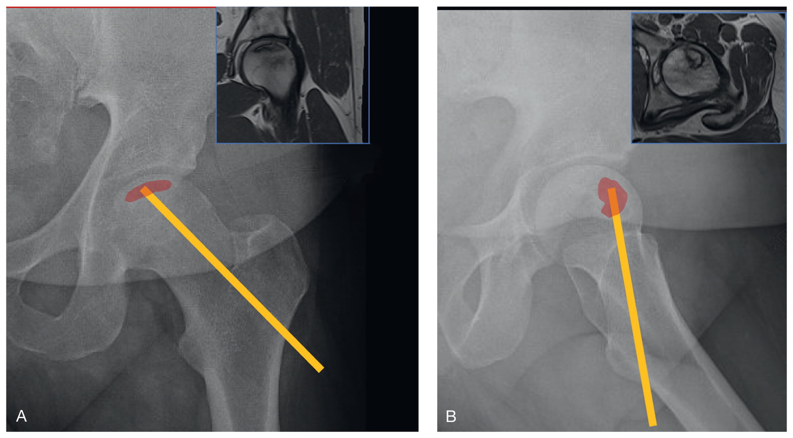 (A·B) 각각 전면(frontal)·측면(lateral) 방사선 사진으로, superior 및 anterior 병변을 동반한 대퇴골 골괴사를 보여준다. 확대 영상은 MRI와의 상관관계를 보여주며, 삽화는 감압 방향